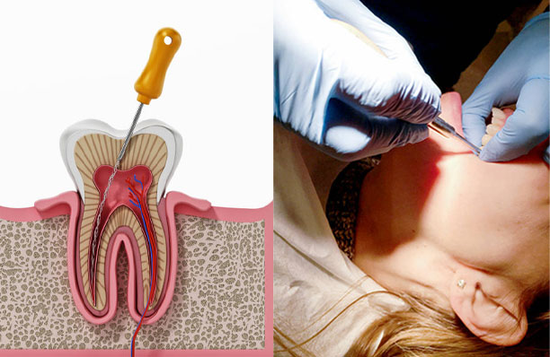 Root Canal Vs Tooth Extraction