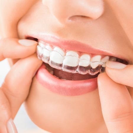 clear aligners in Hyderabad