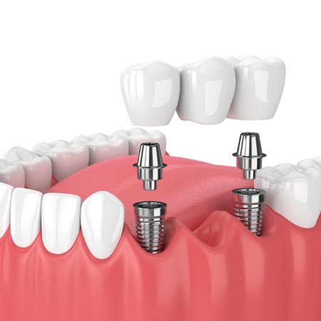 Dental Bridges in Hyderabad