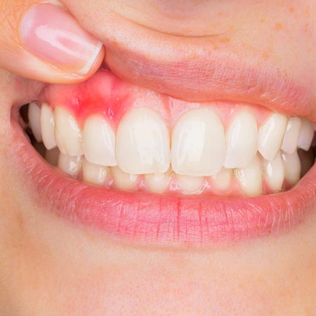 Gingivitis treatment in Hyderabad