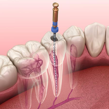 Root Canal treatment in Hyderabad