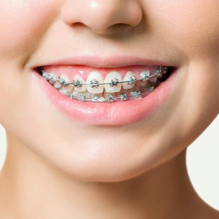 Teeth Braces in Hyderabad