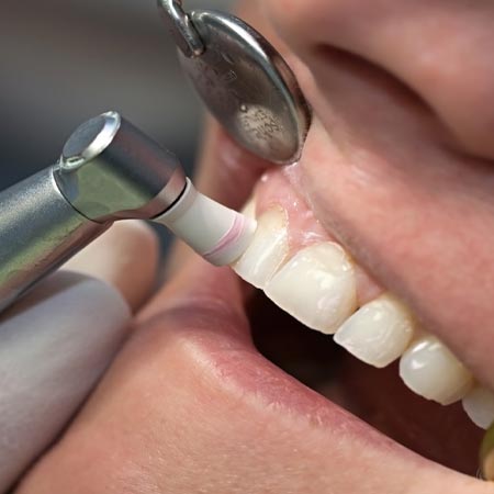 Teeth Cleaning in Hyderabad