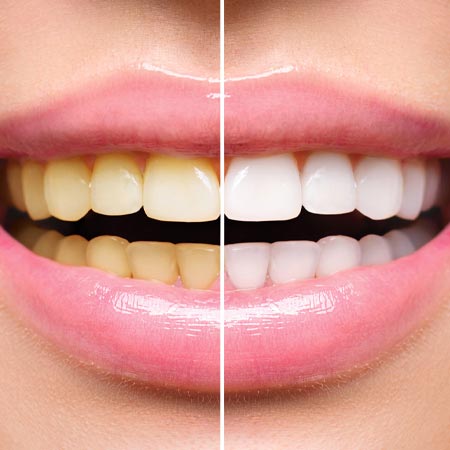 Teeth Whitening in Hyderabad