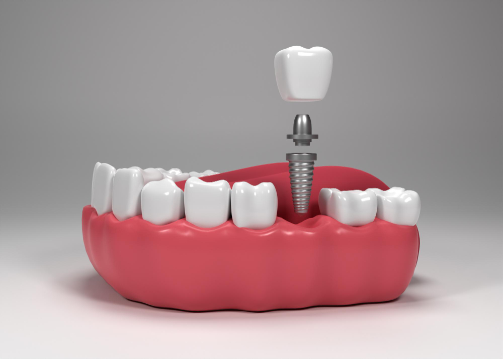 dental implants in Hyderabad