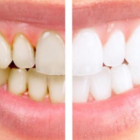 Teeth Scaling in Hyderabad